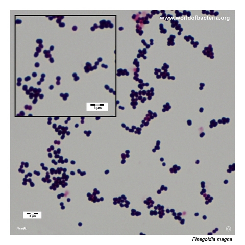 Gram-stained smear of Finegoldia magna showing Gram-positive cocci