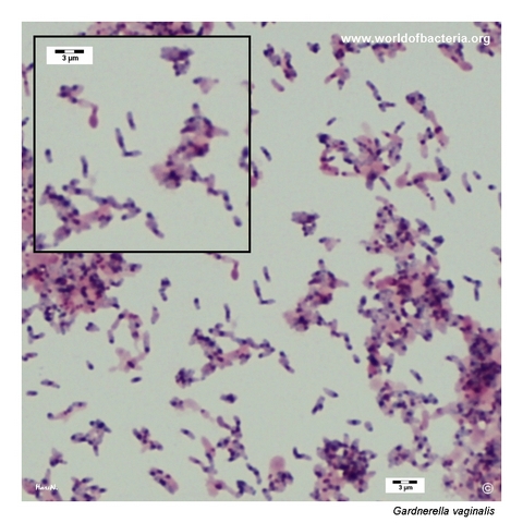 Gram-stained smear of Gardnerella vaginalis showing Gram-variable pleomorphic rods
