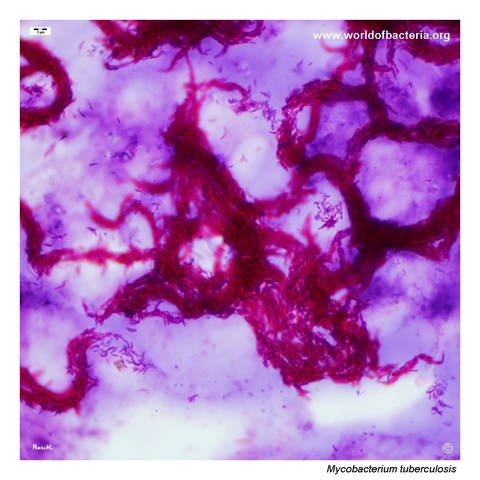 Acid-fast smear from liquid culture showing cording of Mycobacterium tuberculosis