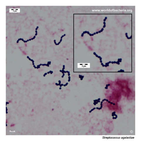 Gram-stained urine smear showing chains of Streptococcus agalactiae