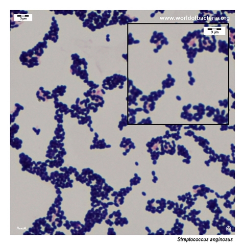 Gram-stained smear of Streptococcus anginosus showing oval cocci in pairs and small groupings