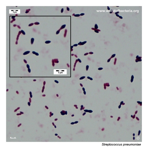 Gram-stained smear of Streptococcus pneumoniae showing Gram-positive diplococci
