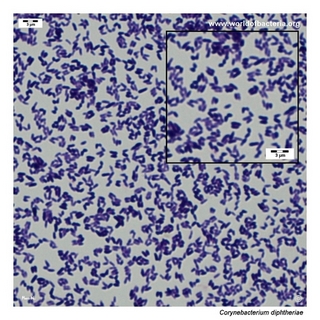 Gram stain microscopy of Corynebacterium diphtheriae showing gram-positive pleomorphic coryneform rods