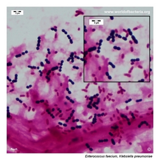 Gram stain microscopy of Enterococcus faecium (Blood culture) showing gram-positive cocci