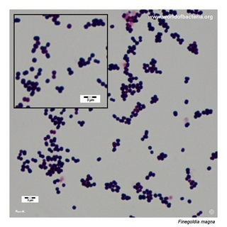 Gram stain microscopy of Finegoldia magna showing gram-positive cocci