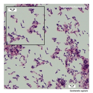 Gram stain microscopy of Gardnerella vaginalis showing gram-variable pleomorphic rods