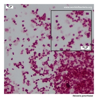 Gram stain microscopy of Neisseria gonorrhoeae showing gram-negative diplococci