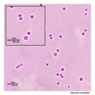 Gram stain microscopy of Neisseria meningitidis showing gram-negative diplococci
