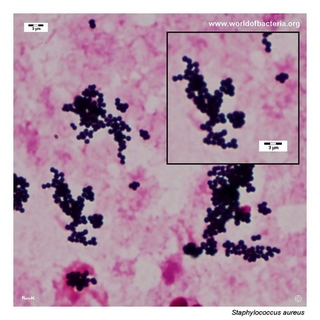 Gram stain microscopy of Staphylococcus aureus showing gram-positive cocci in clusters