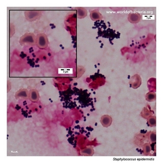 Gram stain microscopy of Staphylococcus epidermidis showing gram-positive cocci in clusters