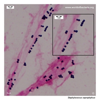 Gram stain microscopy of Staphylococcus saprophyticus showing gram-positive cocci in clusters