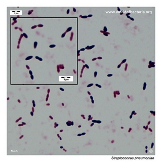 Gram stain microscopy of Streptococcus pneumoniae showing gram-positive diplococci