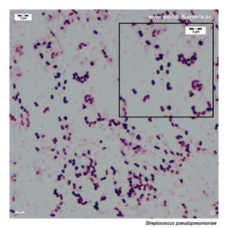 Gram stain microscopy of Streptococcus pseudopneumoniae showing gram-positive diplococci